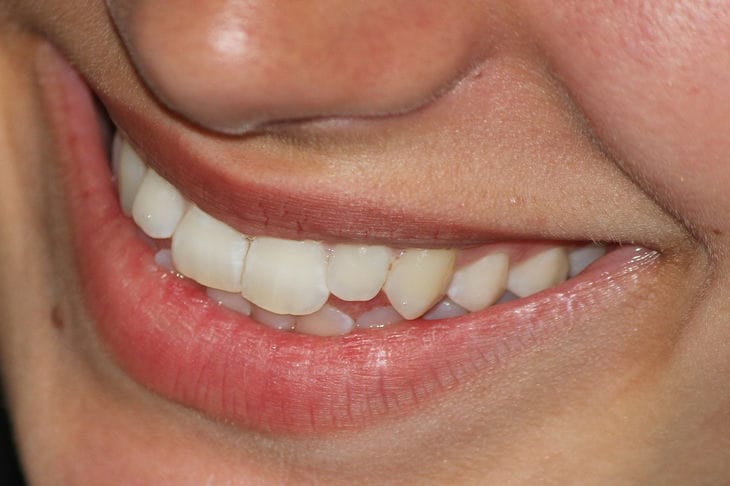 Indian Woman Sets Record for Number of Teeth: Here's How Many Are in 26-Year-Old Kalpana's Mouth Teeth
